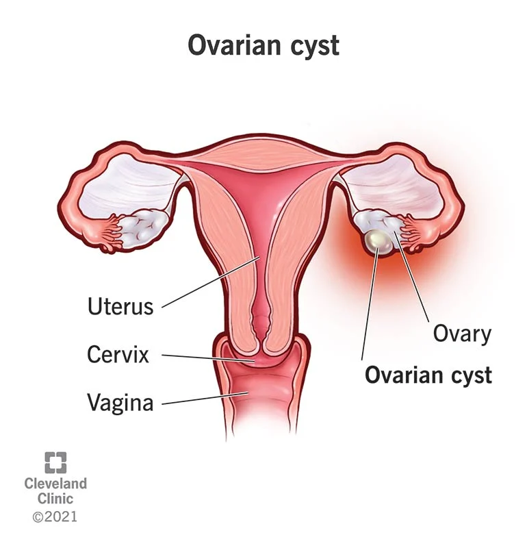 Home Remedies for Ovarian Cyst